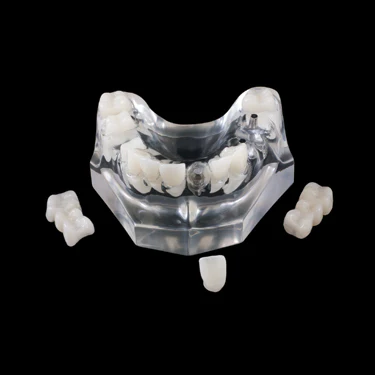 PB-5 Implant Crown & Bridge Combination Questions & Answers