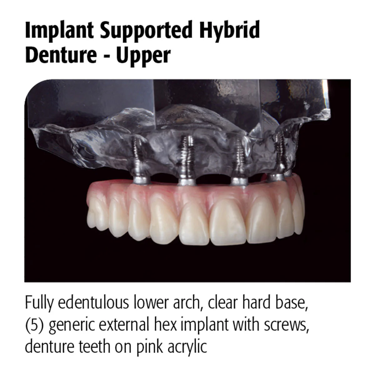 Implant Supported Hybrid Denture – Upper Questions & Answers